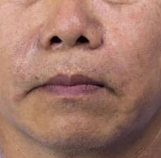 Before/After Image